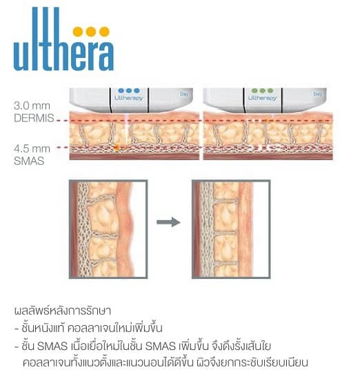 Ulthera ทำที่ไหนดี